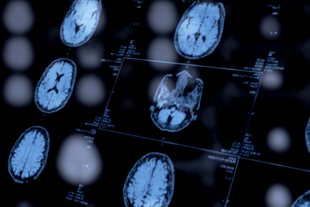 Psychiatrists’ Use of Biomarkers Could Open a New Window Into Mental Health Diagnoses An image of several brain scans on a screen.
